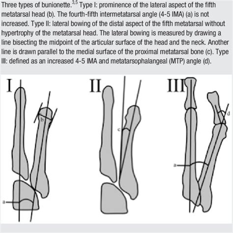 Pdf The Reverse Ludloff Osteotomy For Bunionette Deformity