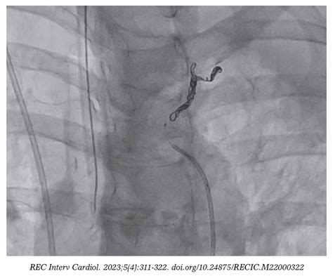 Hemoptisis Masiva Embolizaci N Selectiva De F Stula De Arteria