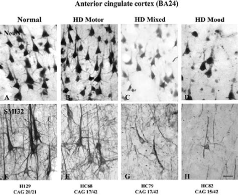 Selective Neurodegeneration Neuropathology And Symptom Profiles In