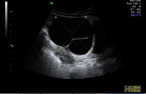 Serous Cystadenoma Ultrasound