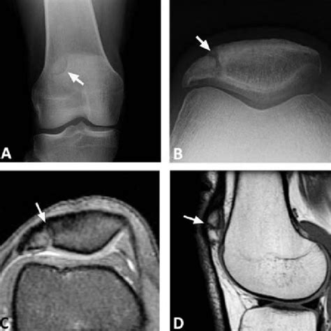 Chondromalacia Patellae Grades Iiiv In Various Patients A Axial