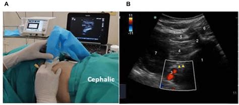 Ultrasound Guided Lumbar Sympathetic Block A An Ultrasound Probe Was