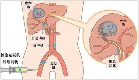 什麼是肝癌介入治療 每日頭條