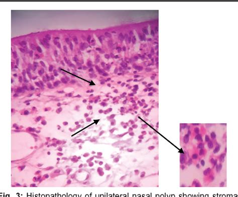 Antrochoanal Polyp Histology