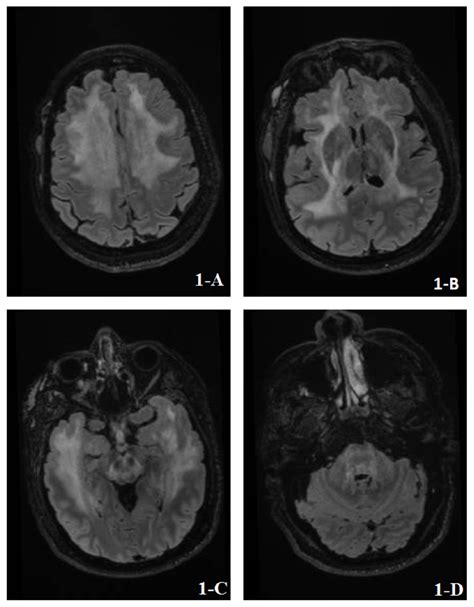 Fluid Attenuated Inversion Recovery Flair Sequence Showed An Download Scientific Diagram