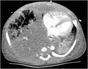 Fetal Lung Interstitial Tumor Case Axial Ct Scan Of The Boy On Day