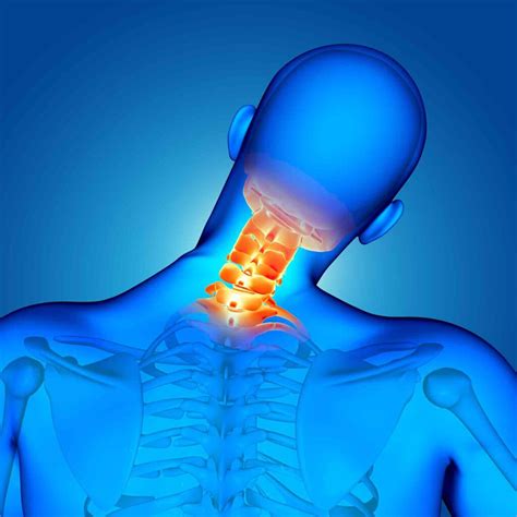 Qué es la artrosis cervical