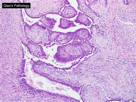 Qiao S Pathology Malignant Phyllodes Tumor Microscopic Ph Flickr