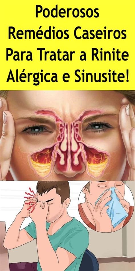 Poderosos Rem Dios Caseiros Para Tratar A Rinite Al Rgica E Sinusite