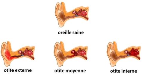 Examen Minutieux Orthodoxe Pr D Cesseur Massage Oreille Otite Sereuse