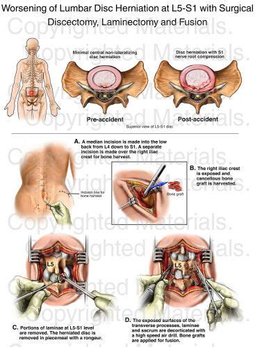 Worsening Of Lumbar Disc Herniation At L S With Surgical Discectomy