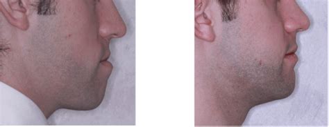 Class 3 Malocclusion Before And After Treatment