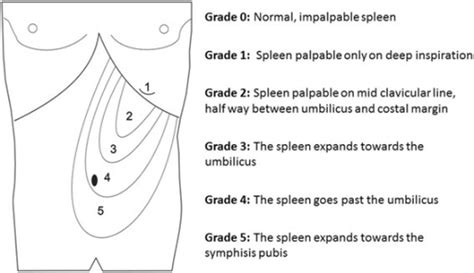 Classification Causes And Complications Of Splenomegaly Medizzy