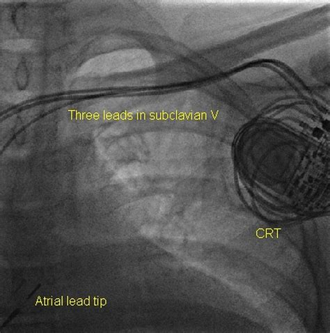 Pictorial Review Of Crt Implantation All About Cardiovascular System And Disorders