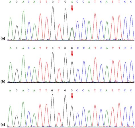 Sanger Sequencing Results For The Patient A And The Patients Father