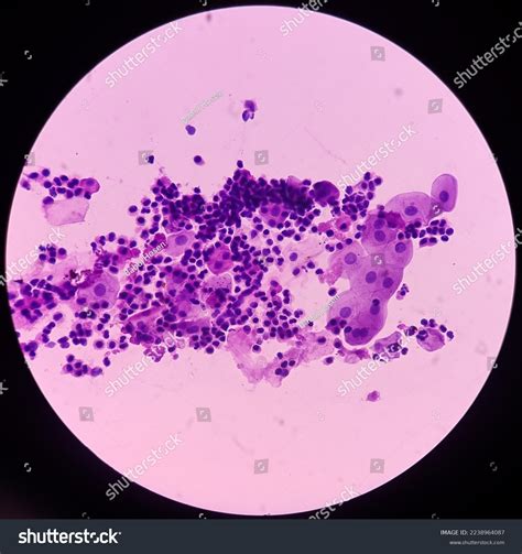 Photomicrograph Urine Microscopy Urine Cytology Pap Stock Photo