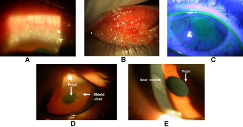 Vernal Keratoconjunctivitis Current Immunological And Clinical