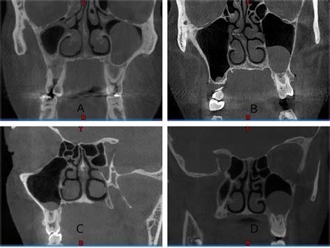 Is The Relationship Of Maxillary Molar Roots To The Floor Of The