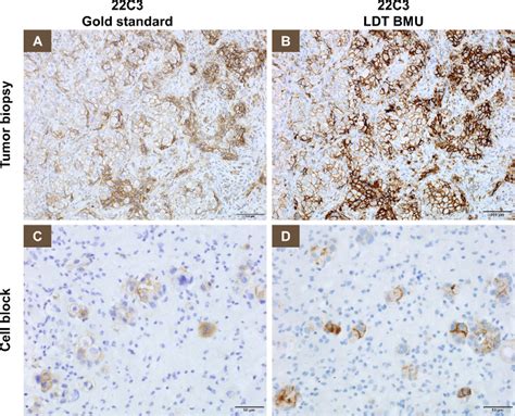 Using C Anti Pd L Antibody Concentrate On Biopsy And Cytology