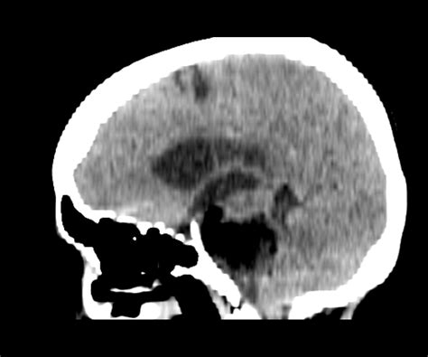 Ruptured Intracranial Dermoid Cyst Cerebellopontine Angle Image