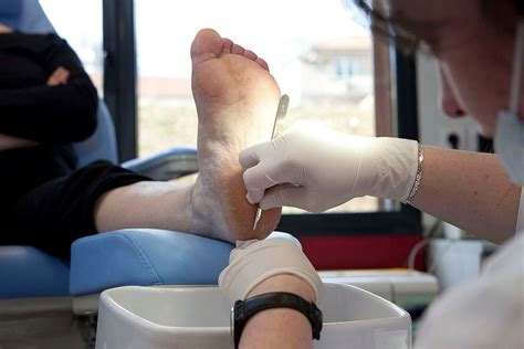 Dear Doctor How Do I Get Rid Of Foot Calluses