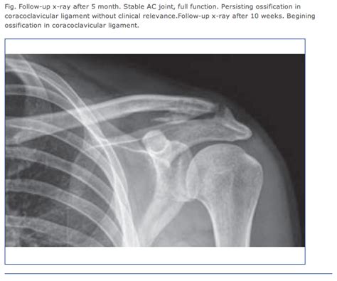 Shoulder And Elbow Surgery Shoulder Separation Or Collar Bone Dislocation Patient Education