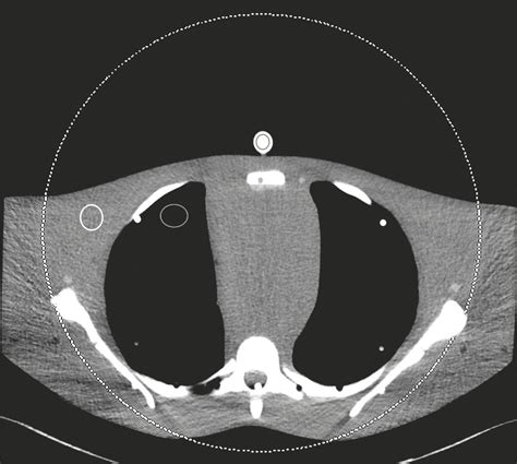 Scielo Brasil Radiation Dose Reduction In Chest Dual Energy