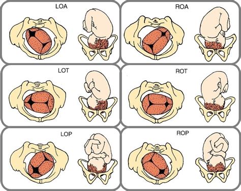 Presentaciones Fetales Posturas Enfermer A Obstetricia Buena Postura