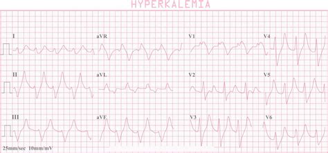 Hyperkalemia causes, signs, symptoms, ECG changes and treatment