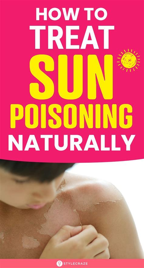 Sun Poisoning Treatment Artofit