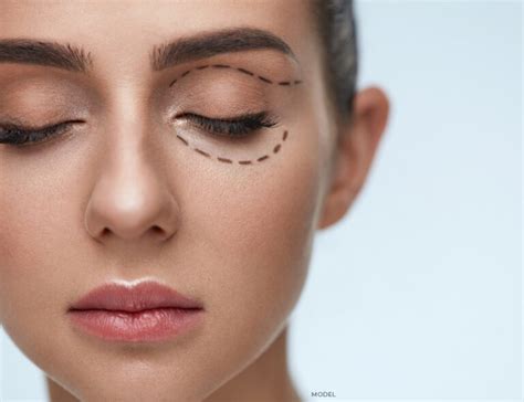 Revision Eyelid Surgery Chicago Eyelid Revision Surgery