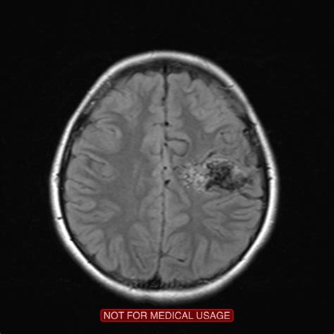 Cerebral Arteriovenous Malformation Image Radiopaedia Org