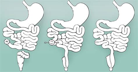 Gastric Health Blog Different Types Of Colectomy Surgery