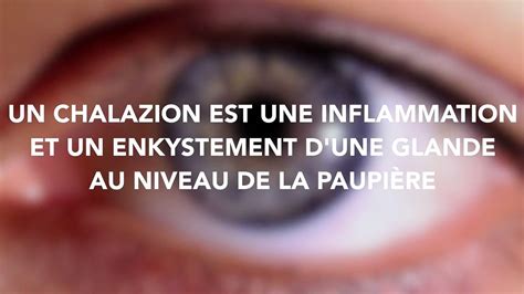 Chalazion définition symptômes traitement causes quelle est cette