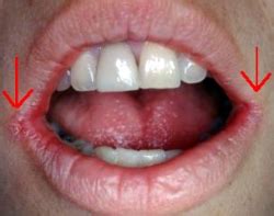 Lips Yeast Infection Symptoms Lipstutorial Org