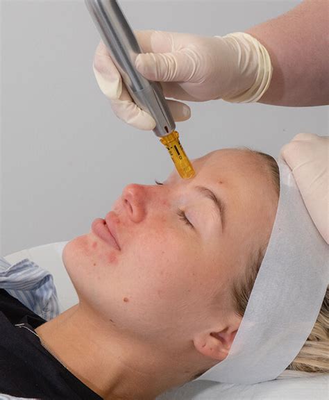 Skin Needling Mesotherapy Brisbane Skin Laser Clinics