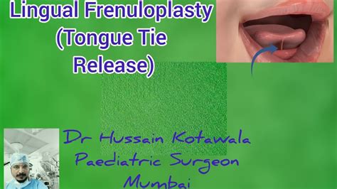 Lingual Frenuloplasty Tongue Tie Release For Ankyloglossia YouTube