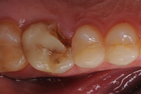 Molar Fracture