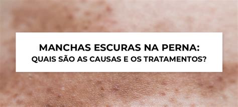 MANCHAS ESCURAS NA PERNA QUAIS SÃO AS CAUSAS E OS TRATAMENTOS Blog