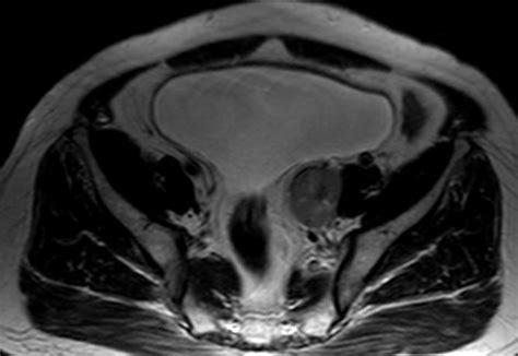 Pelvic Schwannoma Image Radiopaedia Org