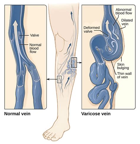 Varicose Veins And Spider Veins I Vascular Center