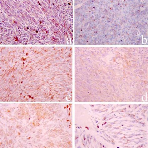 Cxcr Cxcl And Vegf Expression In Primary Uveal Melanoma A High