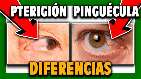 🟩 Pterigion Y Pinguecula Diferencias Tratamientos Prevención Cap