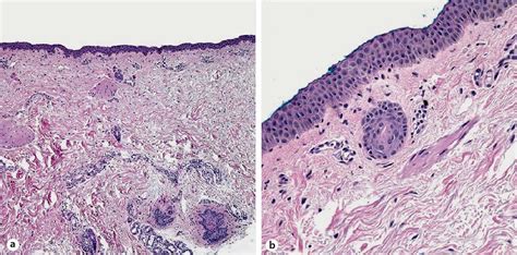 Staphylococcal Scalded Skin Syndrome Histology