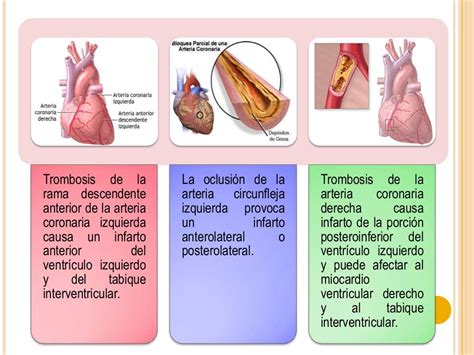 Infarto Agudo De Miocardio