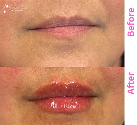 Lip Fillers Before And After Photos Get A Consultation Now