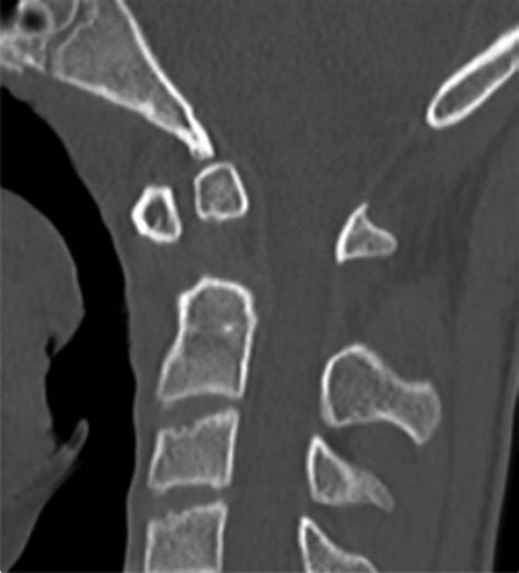 25 Os Odontoideum | Radiology Key