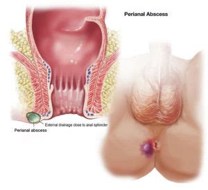 Anal Fistula Anal Fissure Treatment Encino Zadeh Surgical Inc