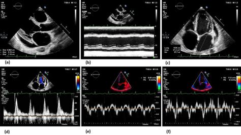 Echocardiographic evaluation of heart failure. Echocardiography plays a ...