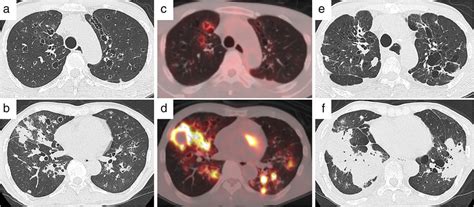 Chest Radiological Findings In A Patient With Silicosis Chest Computed